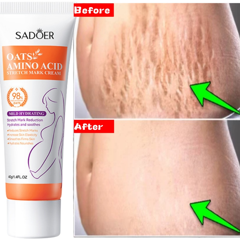 Stretch Marks Permanent Remova - Skincare Oat บทวิจารณ์และราคา