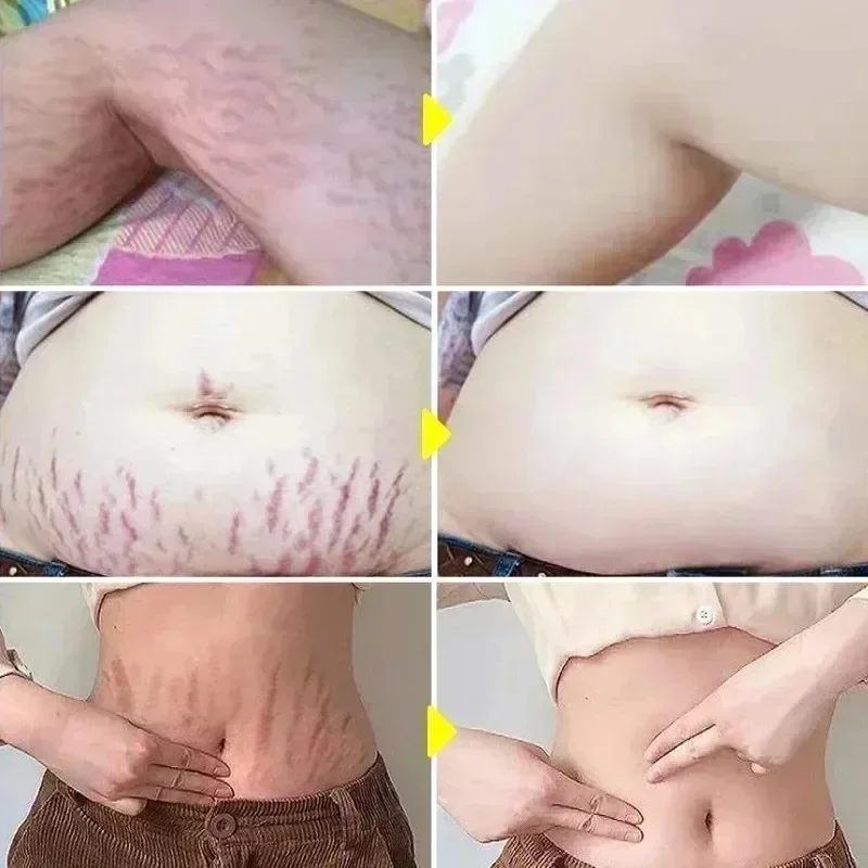 Stretch Marks Permanent Remova - Skincare Oat บทวิจารณ์และราคา