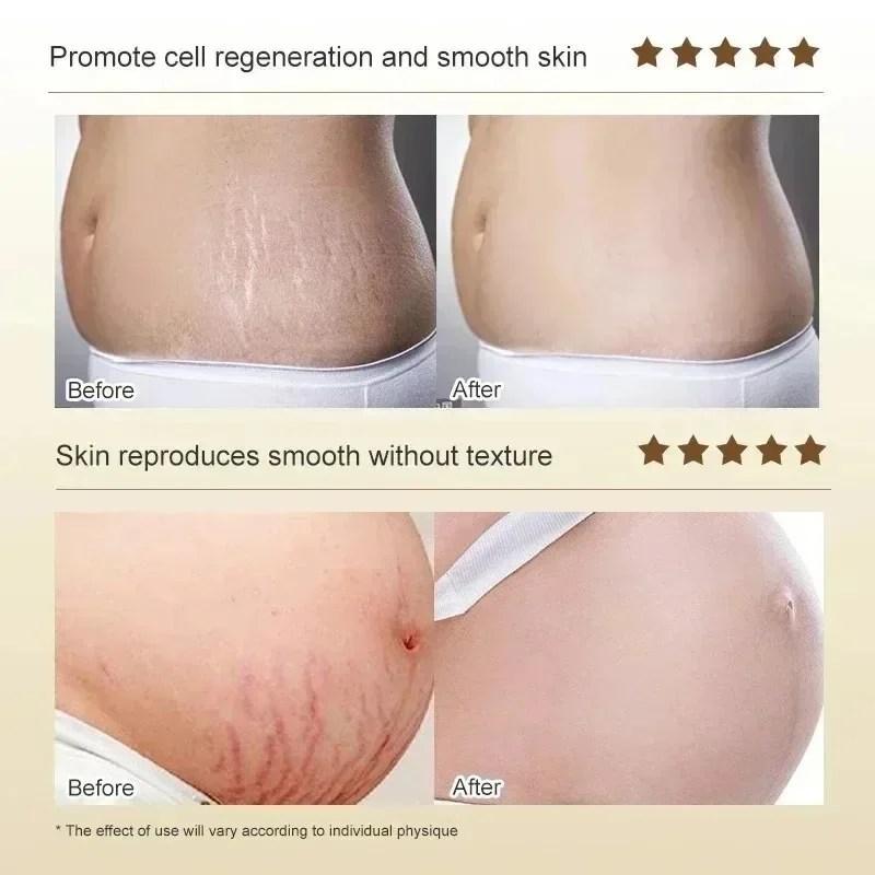 Stretch Marks Permanent Remova - Skincare Oat บทวิจารณ์และราคา